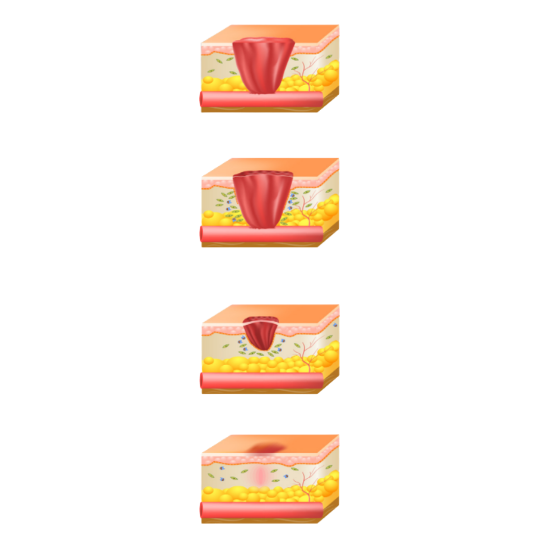 ActiGraft Autologous Blood Clot Therapy for Chronic Wounds