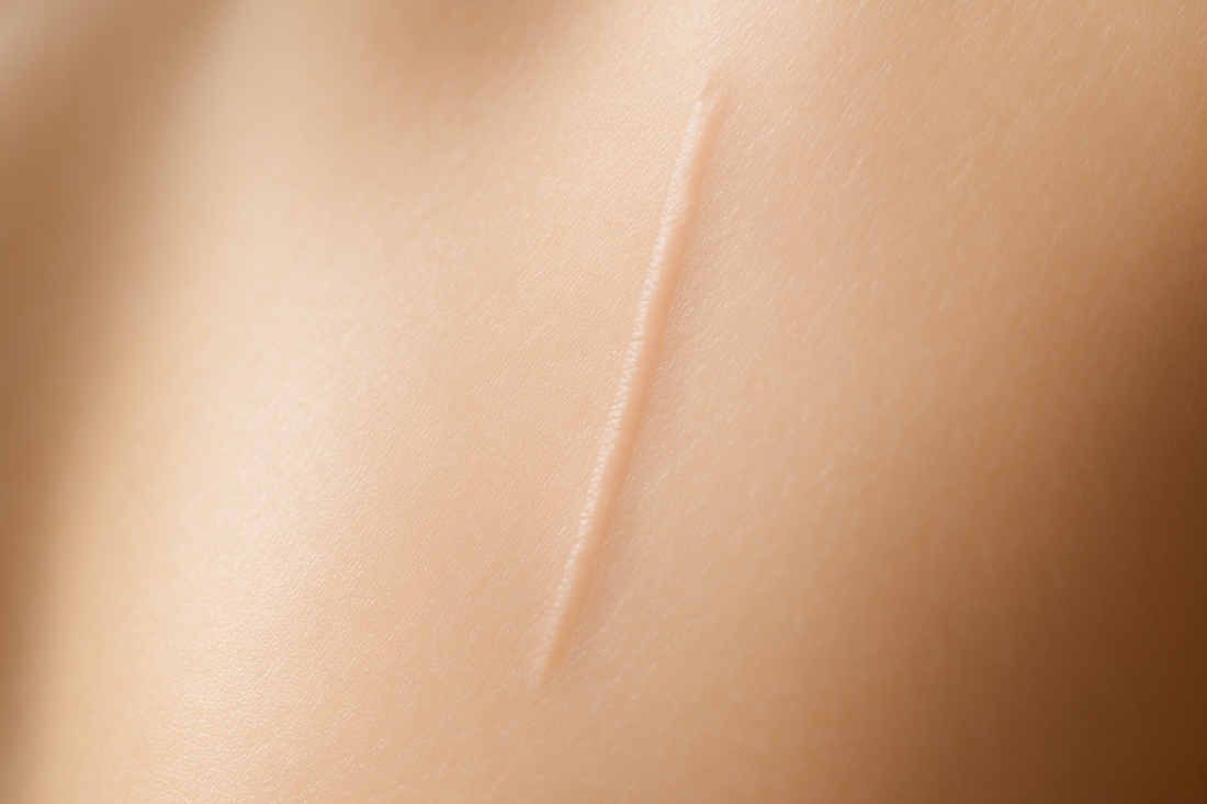 Beyond Traditional Camouflage: Revolutionizing Dark Scar Treatment with Advanced Lightening Techniques