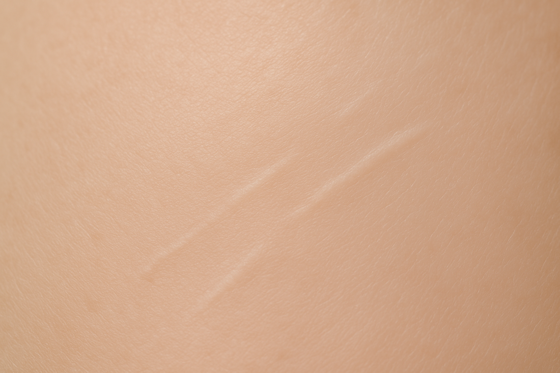 Optimizing Scar Revision: Advanced Techniques for Professional Scar Lightening and Cosmetic Camouflage