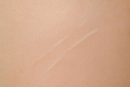 Optimizing Scar Revision: Advanced Techniques for Professional Scar Lightening and Cosmetic Camouflage