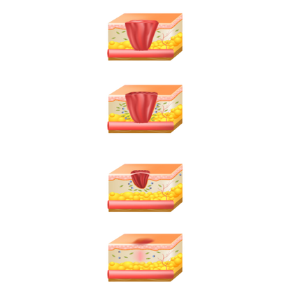 ActiGraft Autologous Blood Clot Therapy for Chronic Wounds