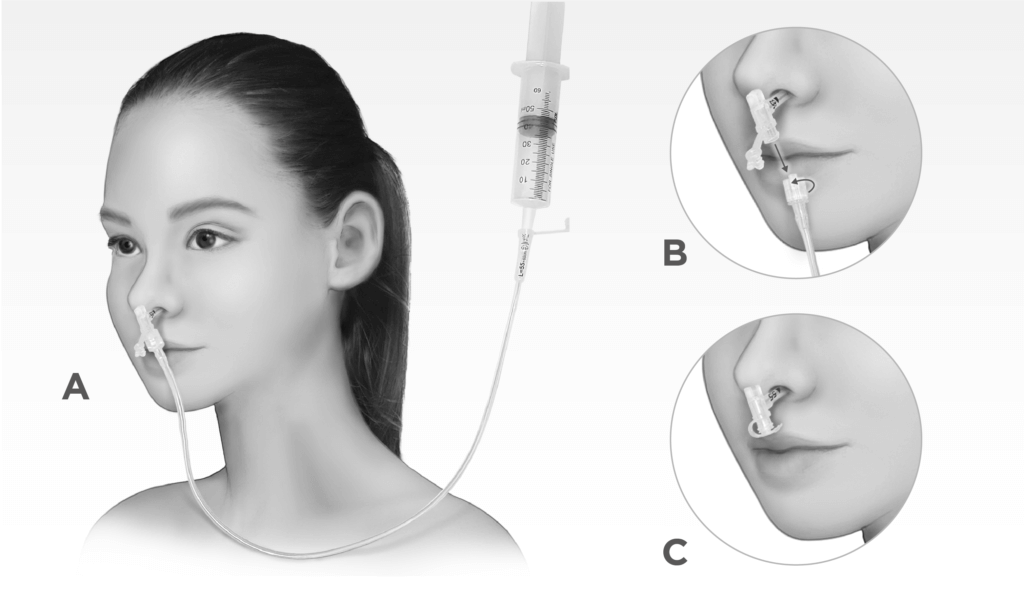 Silicone Nasogastric Tube Detachable Type for Long Term Enteral Feeding