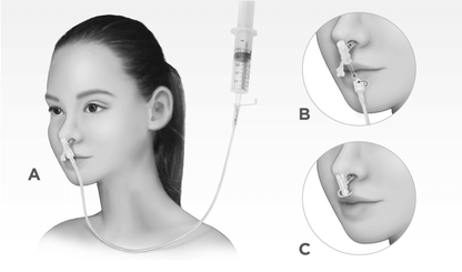 Silicone Nasogastric Tube Detachable Type for Long Term Enteral Feeding