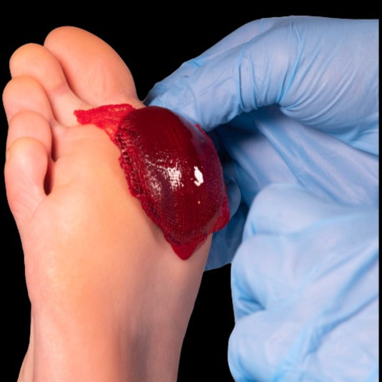 RedDress’s ActiGraft® Technology Autologous Blood Clot Therapy for Chronic Wound