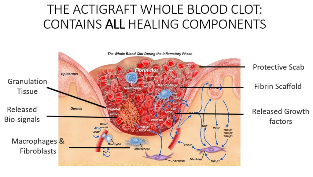 RedDress’s ActiGraft® Technology Autologous Blood Clot Therapy for Chronic Wound