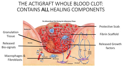 ActiGraft Autologous Blood Clot Therapy for Chronic Wounds